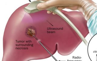 RF ablation