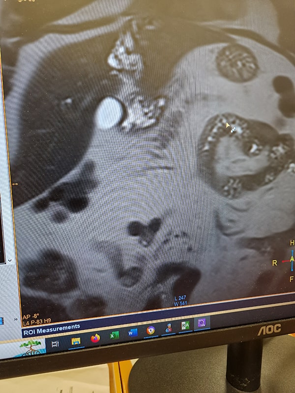 Χειρουργός Πάγκρεας Σπύρος Δελής Ηπατολιθιαση Αρ ηπατικού λοβού Left lateral Hepatectomy