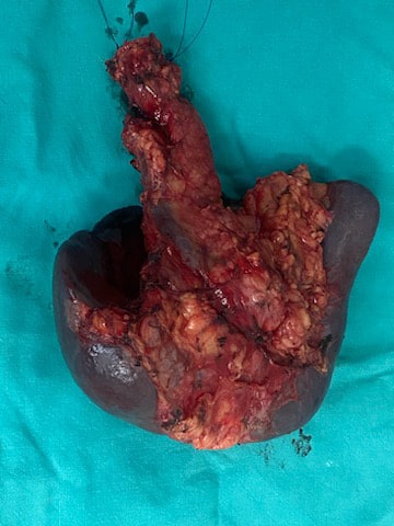 Σπύρος Δελής Χειρουργός πάγκρεας IPMN of pancreas