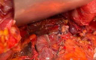 Σπύρος Δελής Χειρουργός Πάγκρεας Adenocarcinoma of pancreas