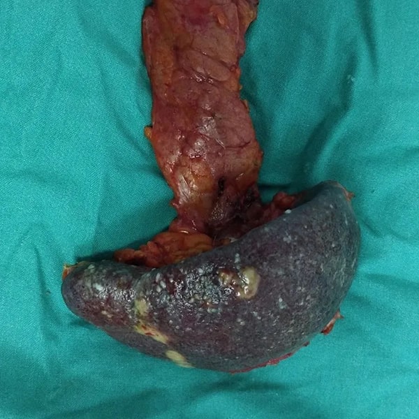 Σπύρος Δελής Χειρουργός Πάγκρεας Adenocarcinoma of pancreas