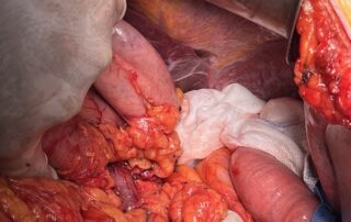 Σπύρος Δελής Χειρουργός Πάγκρεας Περιφερική παγκρεατεκτομή για Μεταστατικό Καρκίνο νεφρού
