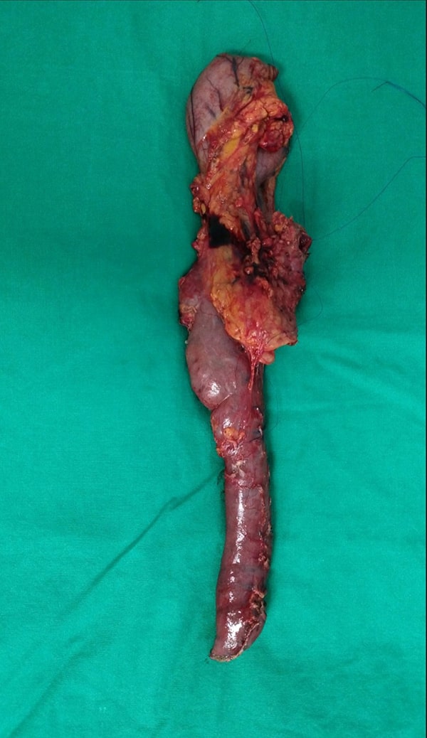 Pancreatoduodenectomy-Σπύρος Δελής Χειρουργός Πάγκρεας