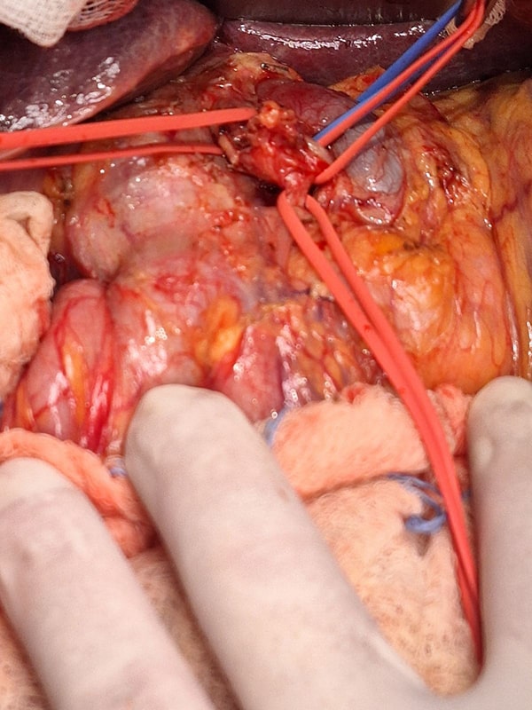 Whipple with retroportal hepatic artery - Σπύρος Δελής Χειρουργός Πάγκρεας