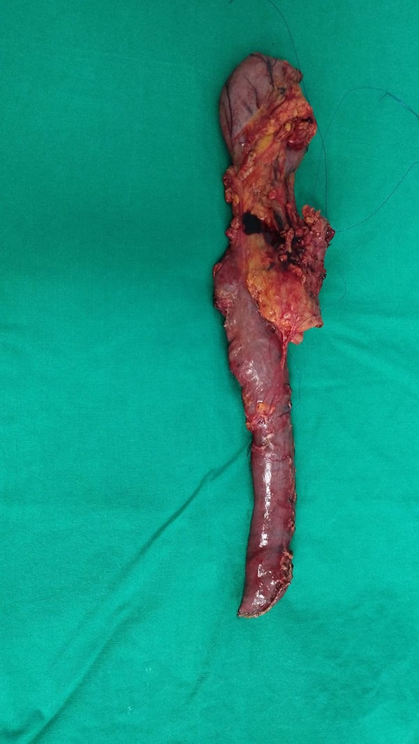 Whipple with retroportal hepatic artery - Σπύρος Δελής Χειρουργός Πάγκρεας