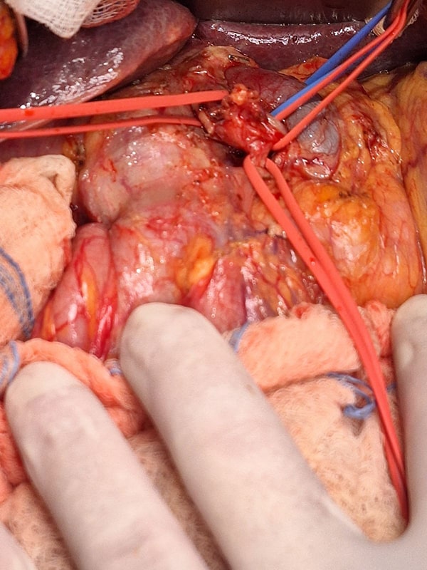 Whipple with retroportal hepatic artery - Σπύρος Δελής Χειρουργός Πάγκρεας