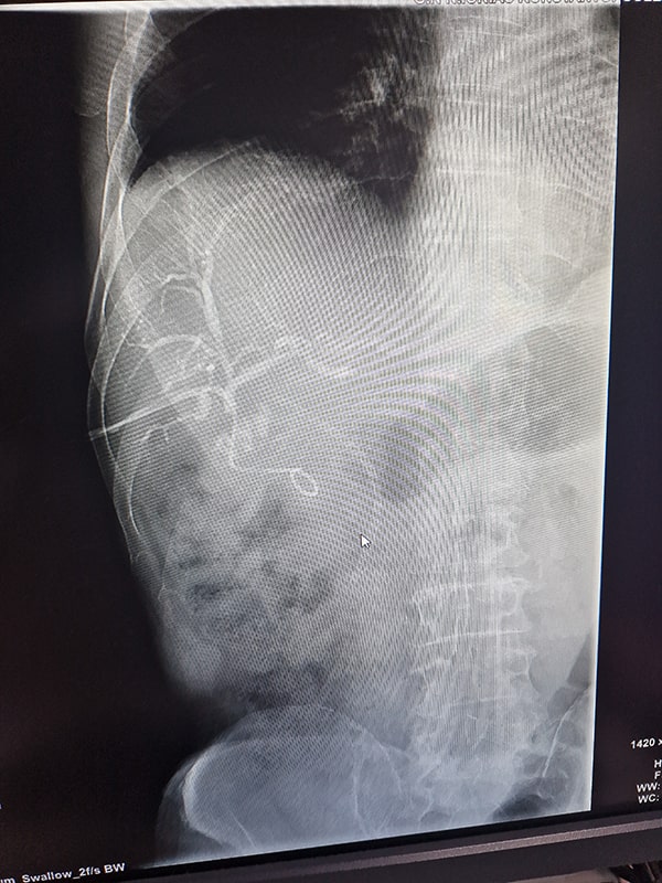 Σπύρος Δελής Χειρουργός Πάγκρεας - E4 Strasberg injury