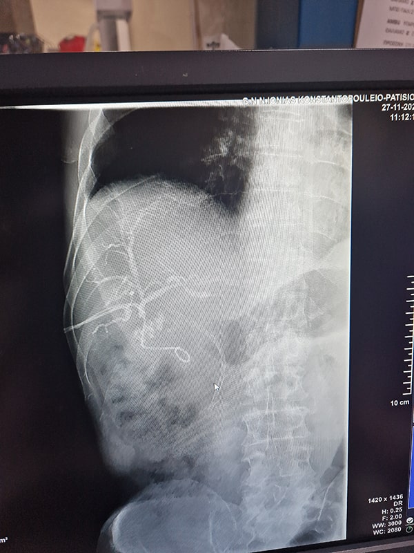 Σπύρος Δελής Χειρουργός Πάγκρεας - E4 Strasberg injury