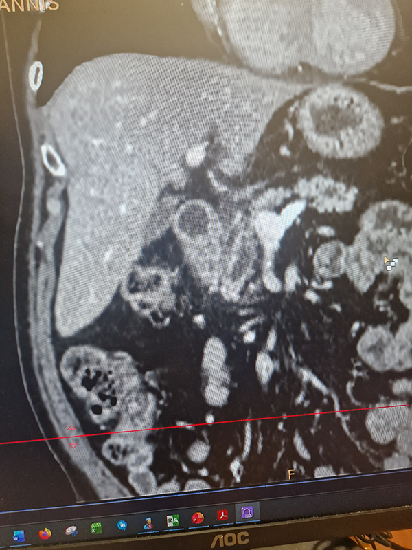 Αδενοκαρκίνωμα φύματος παγκρέατος σε pancreas divisum - Σπύρος Δελής Χειρουργός Πάγκρεας