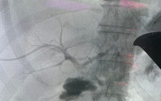 Ιατρογενείς κακώσεις χοληφόρων - Σπύρος Δελής Χειρουργός Πάγκρεας