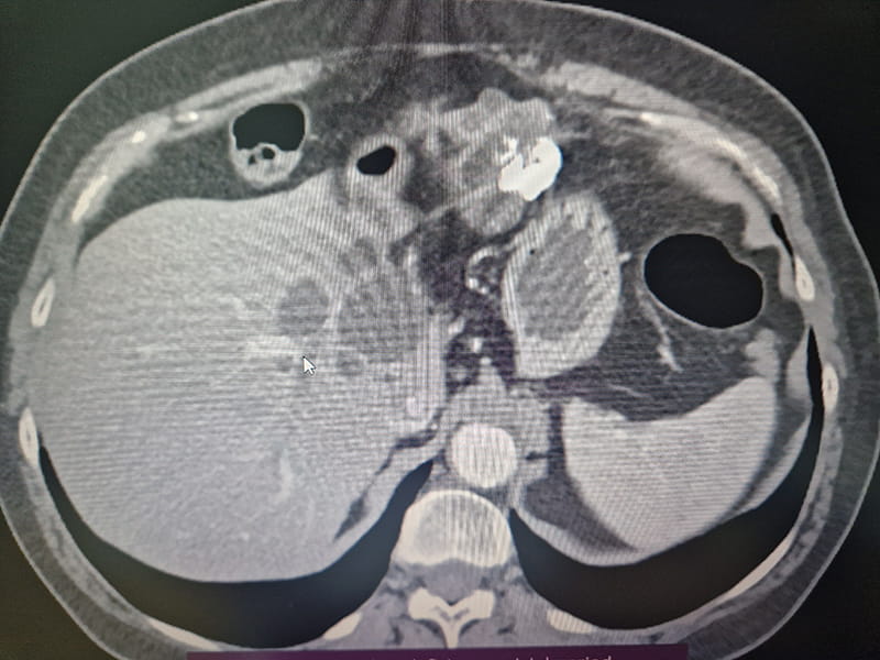 Choledochal cyst - Σπύρος Γ. Δελής | Γενικός Χειρουργός MD, Ph.D , ASTS