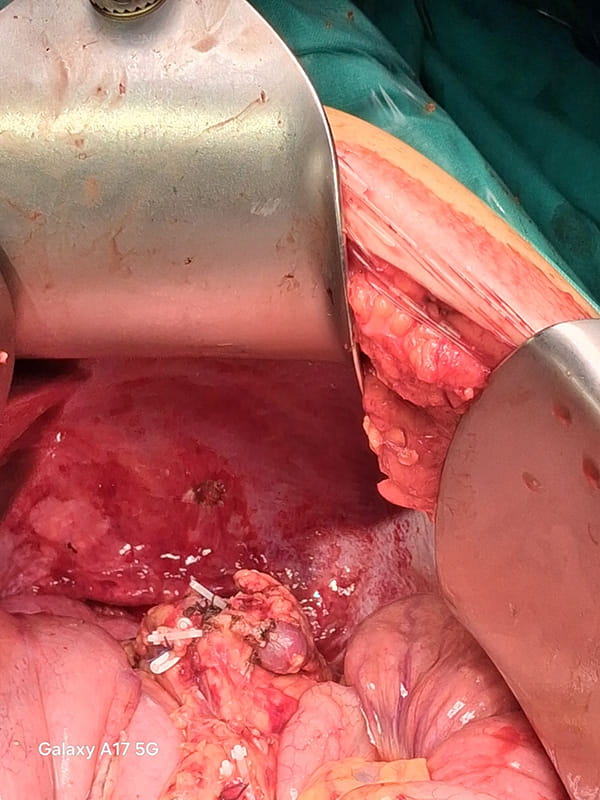 Cystic tumor of the spleen - Σπύρος Γ. Δελής Γενικός Χειρουργός MD, Ph.D , ASTS