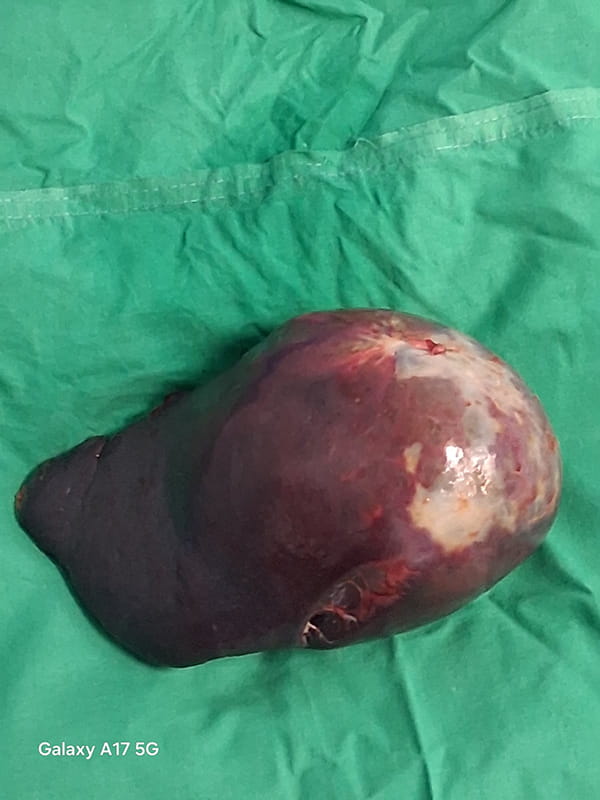 Cystic tumor of the spleen - Σπύρος Γ. Δελής Γενικός Χειρουργός MD, Ph.D , ASTS